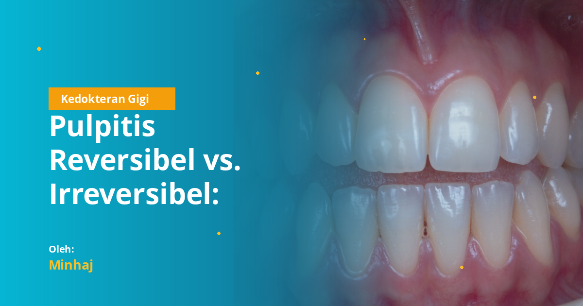 Pulpitis Reversibel vs. Irreversibel: Panduan Lengkap Protokol Penanganan Nyeri Akut