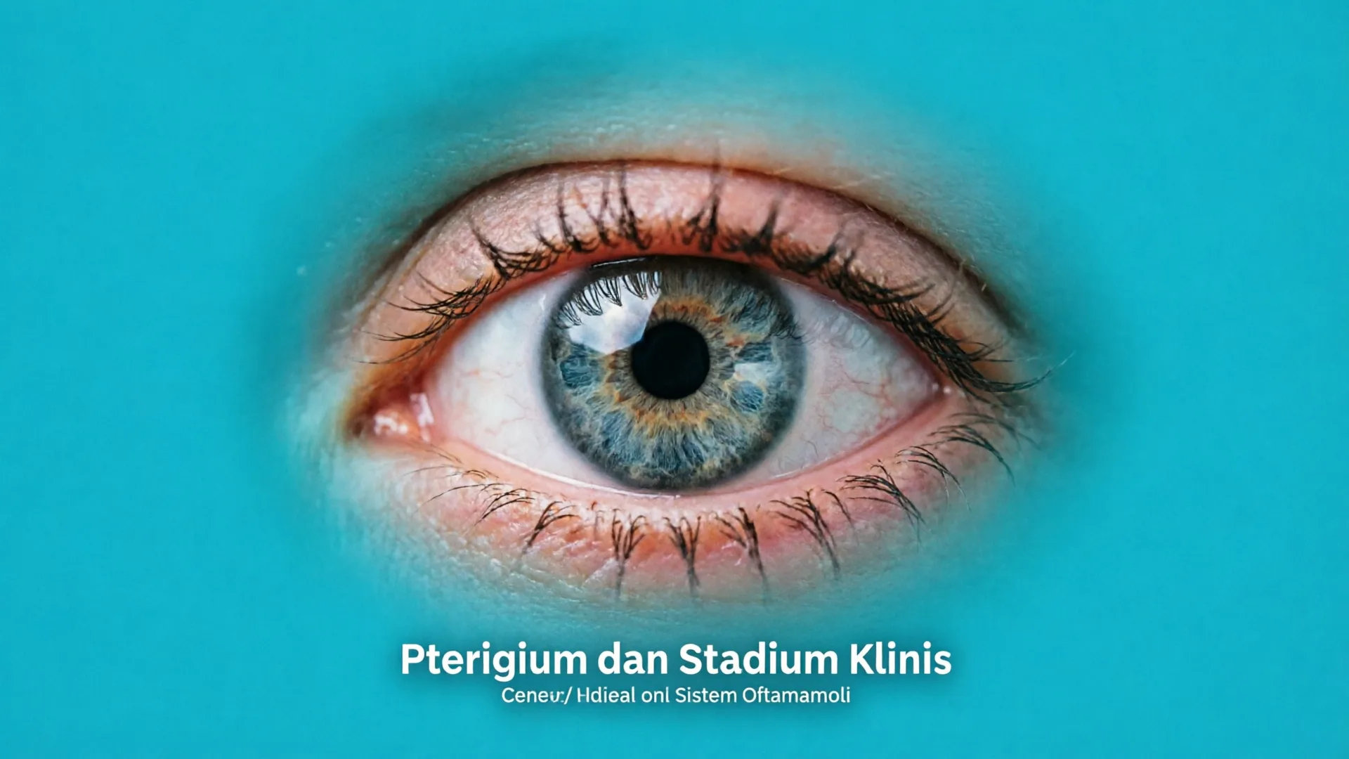 Pterigium dan Stadium Klinis