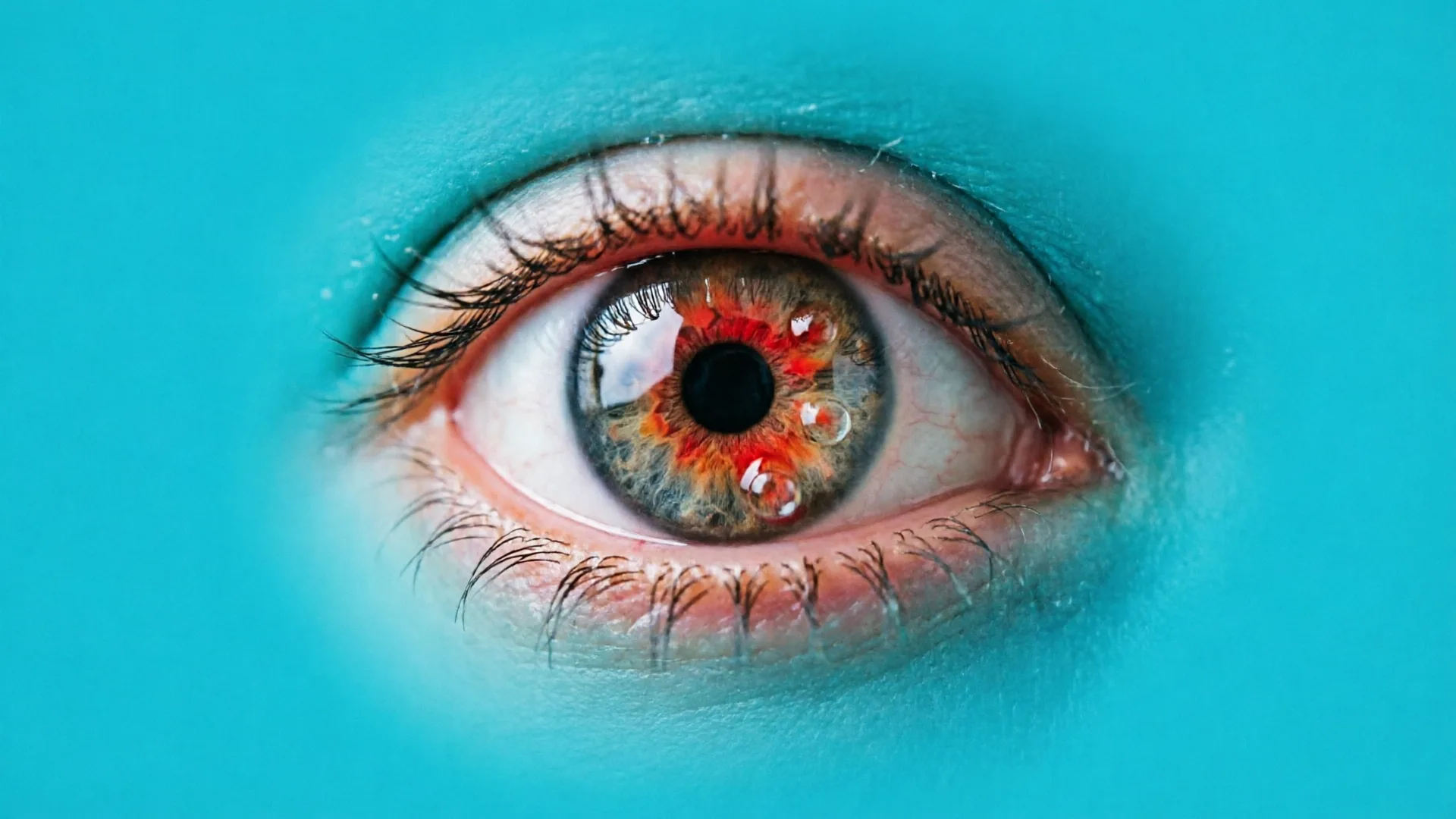 Keratitis, Ulkus Kornea dan Mata Merah dengan Penurunan Penglihatan