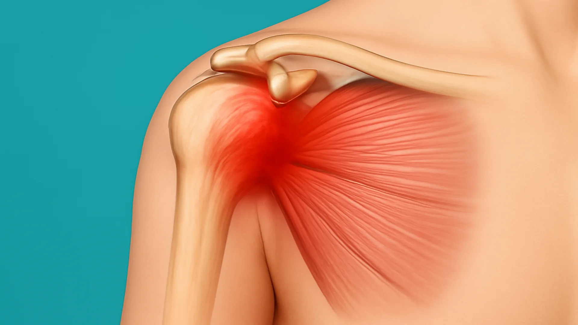 Soft T Injury