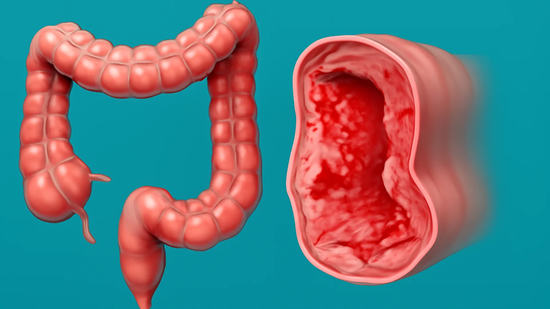 IBD (Crohn vs Kolitis Ulseratif)