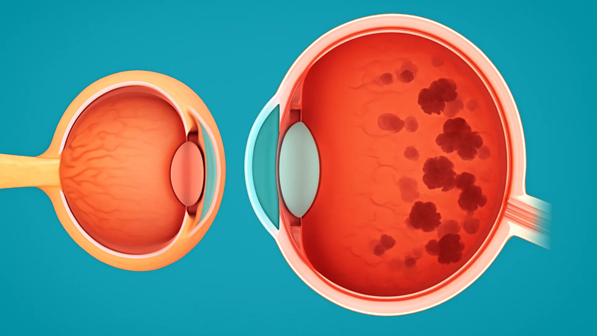 Neuritis Optik / Atrofi Optik / Retinitis Pigmentosa