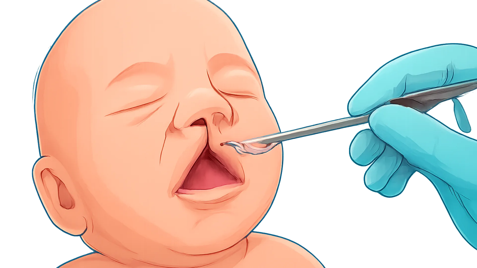 Cleft Lip Palate
