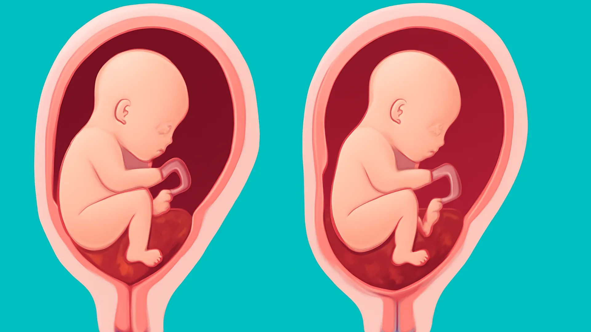Plasenta Previa vs Solusio Placenta