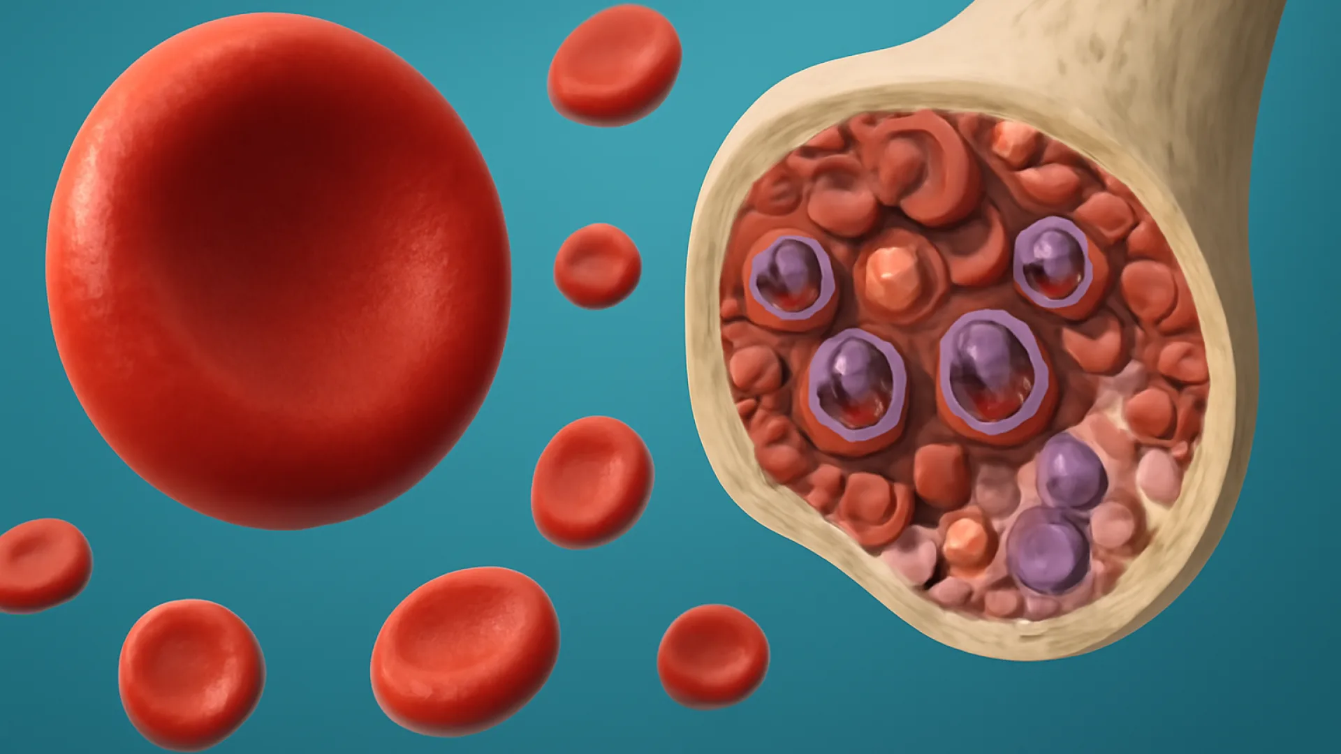 Anemia Sideroblastik