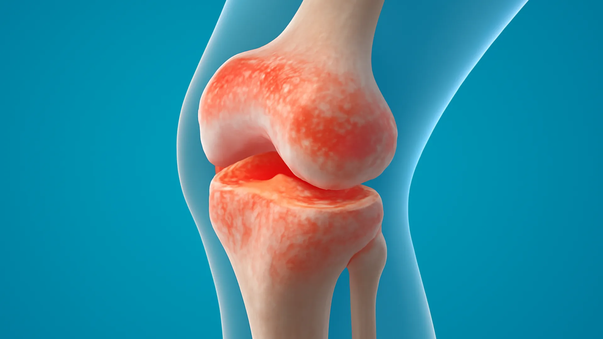 Arthritis detail