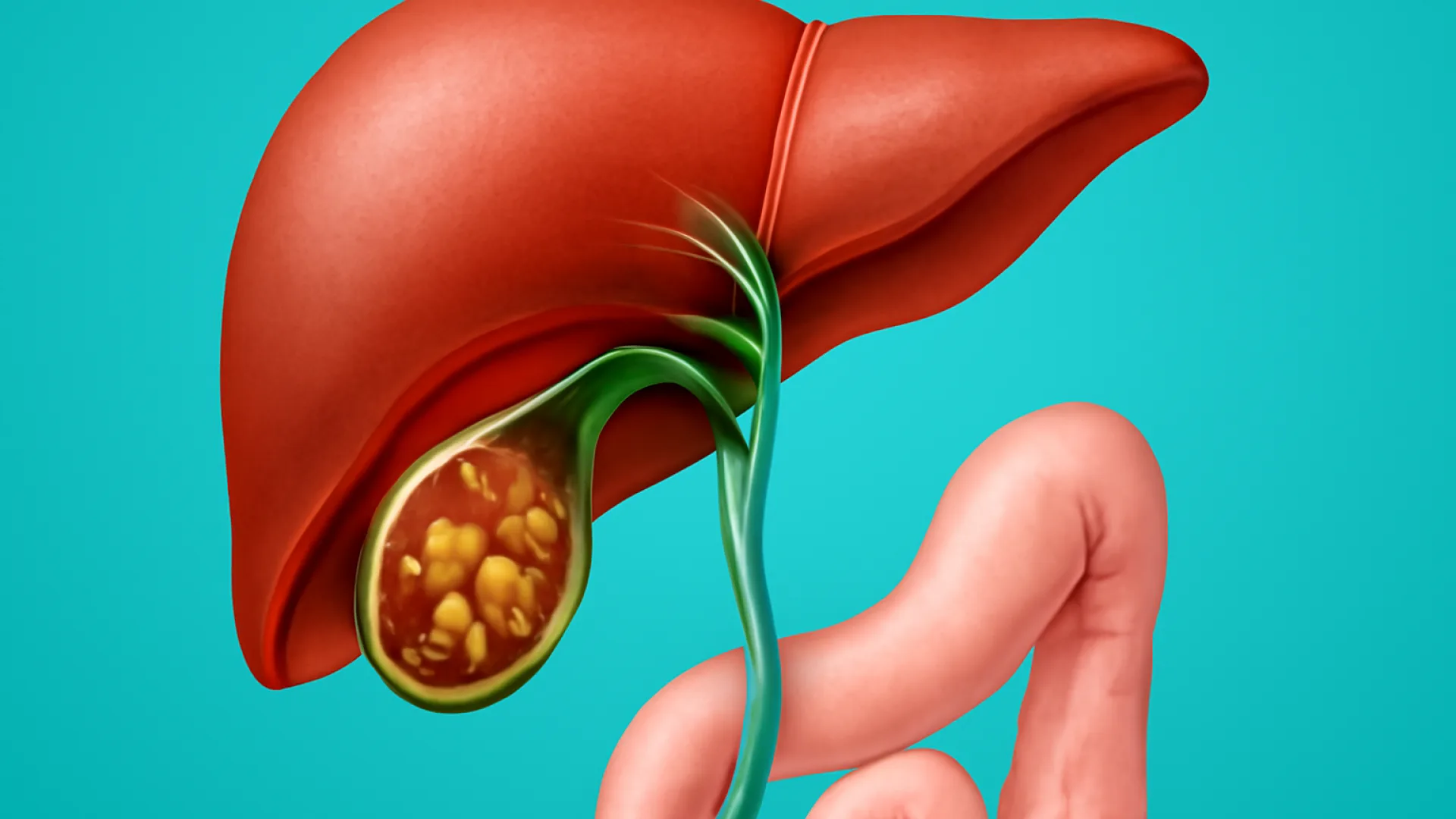 Kolesistitis / Kolelitiasis