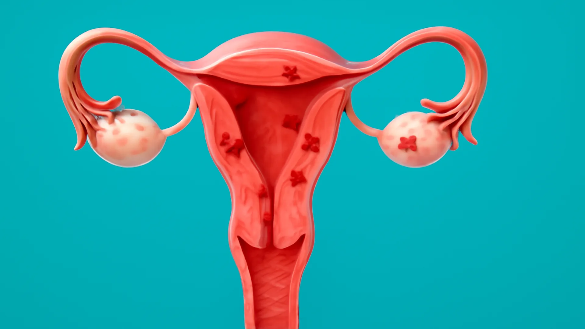 Endometriosis / Adenomiosis
