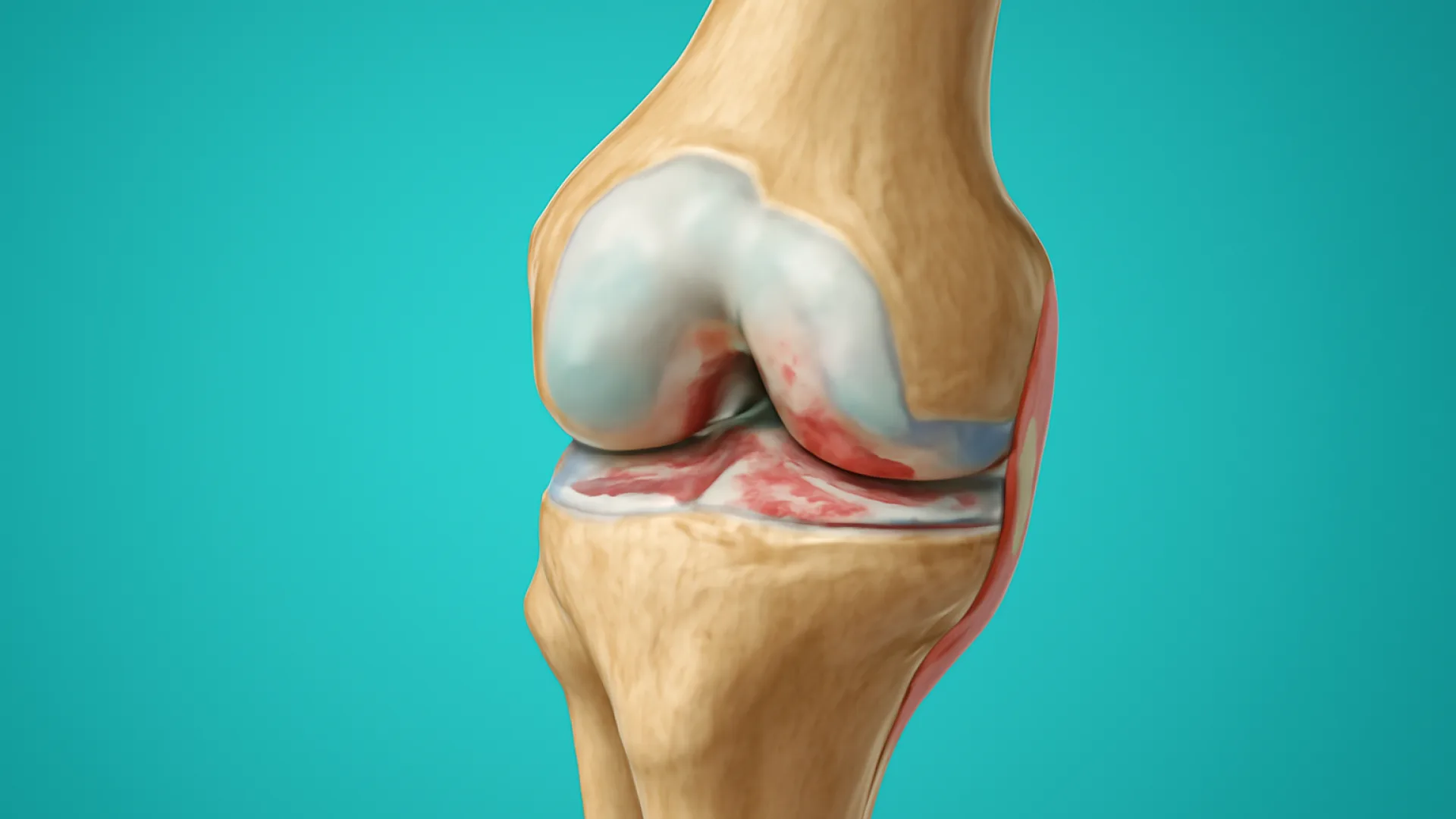 Osteoarthritis