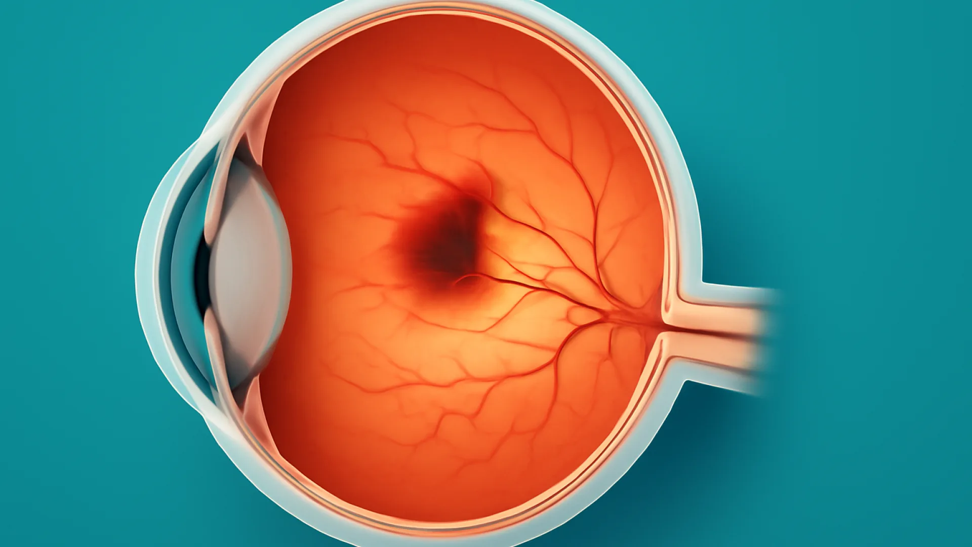 Oklusi Vaskular Retina