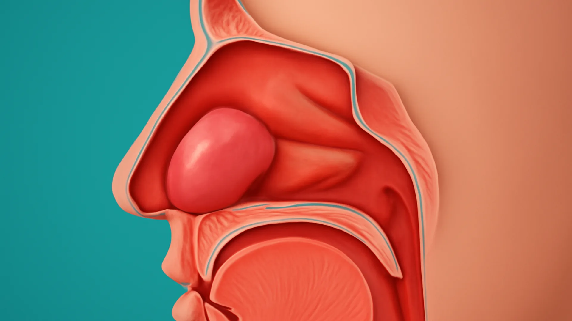 Polip Nasi / Deviasi Septum