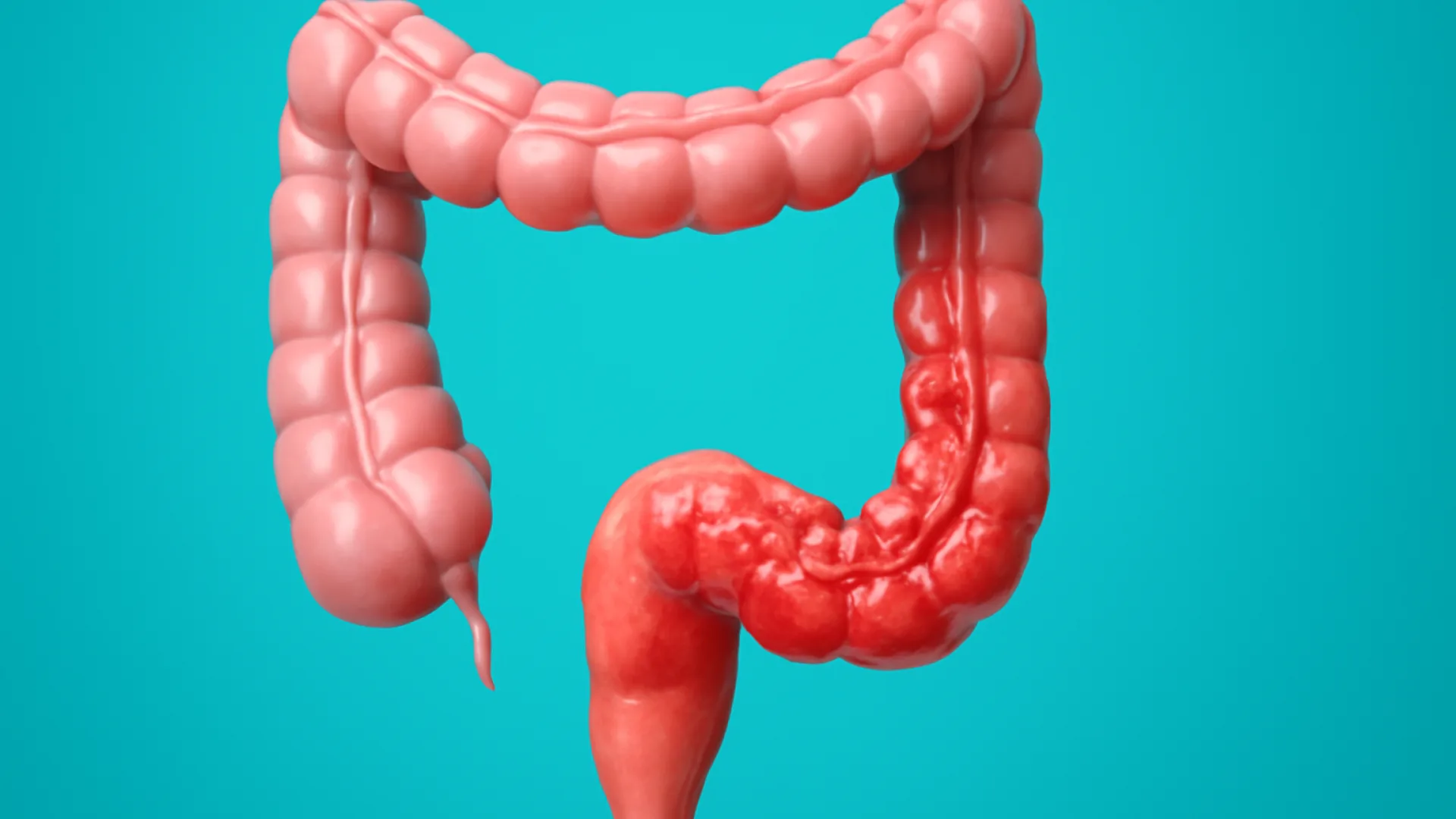 Tabel: IBD