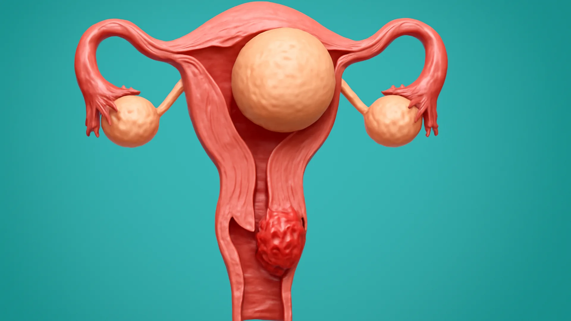 Mioma Uteri / Ca Serviks