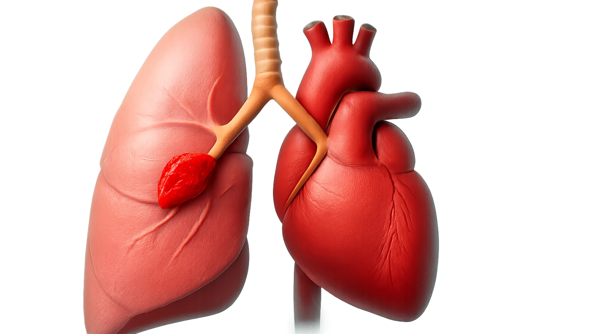 Pulmonary Embolism