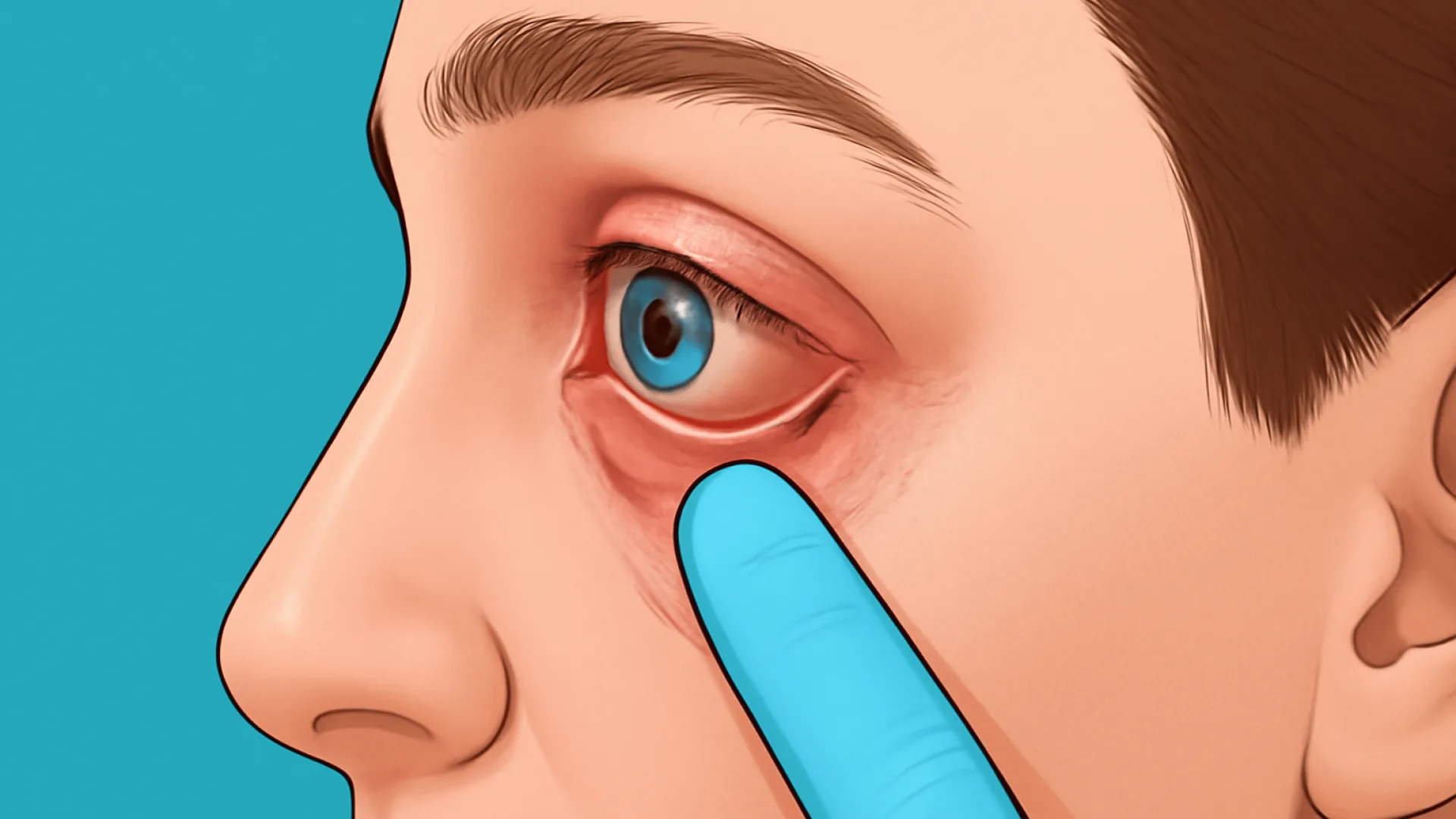 Konjungtivitis Viral