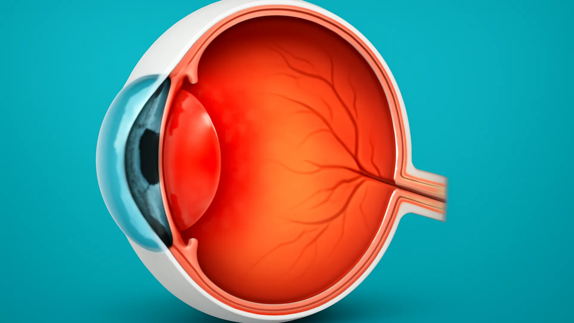 Tabel: Uveitis Anterior/Posterior