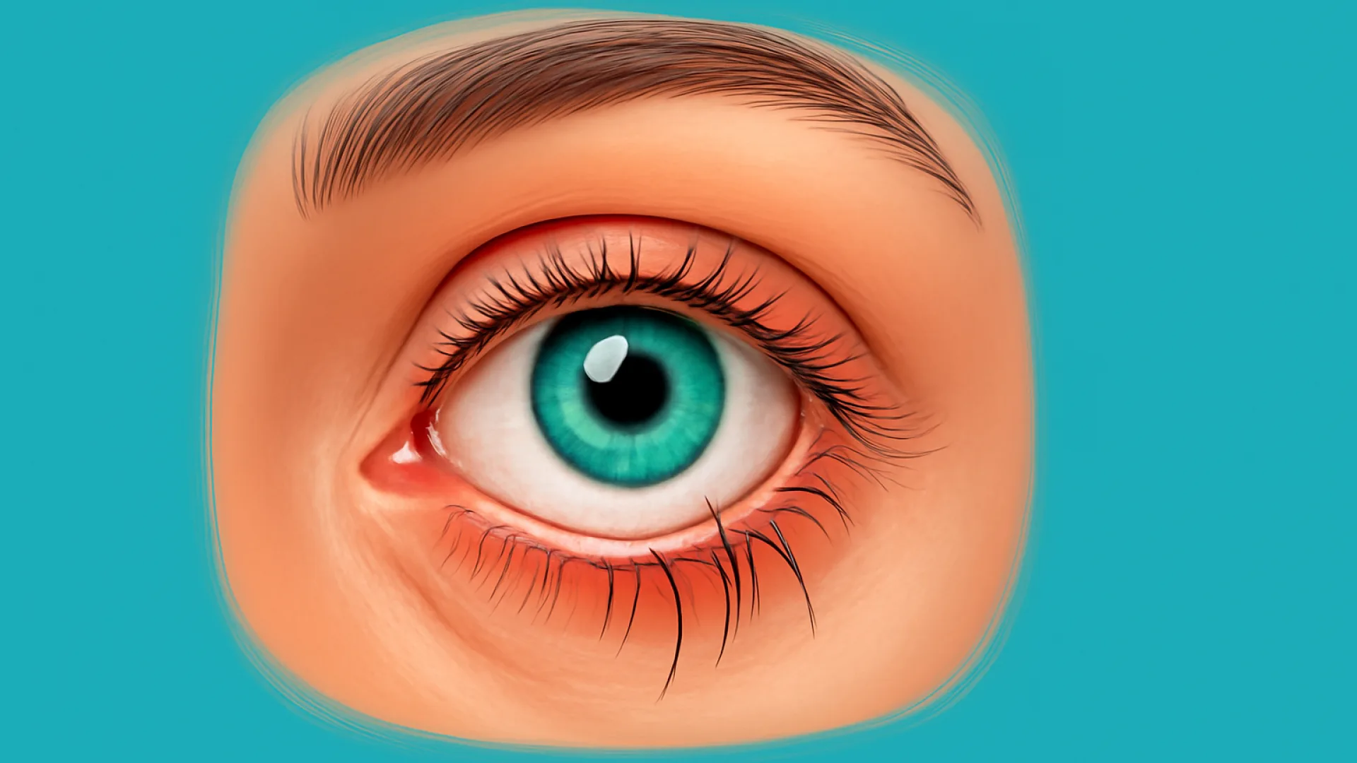 Trichiasis / Districhiasis