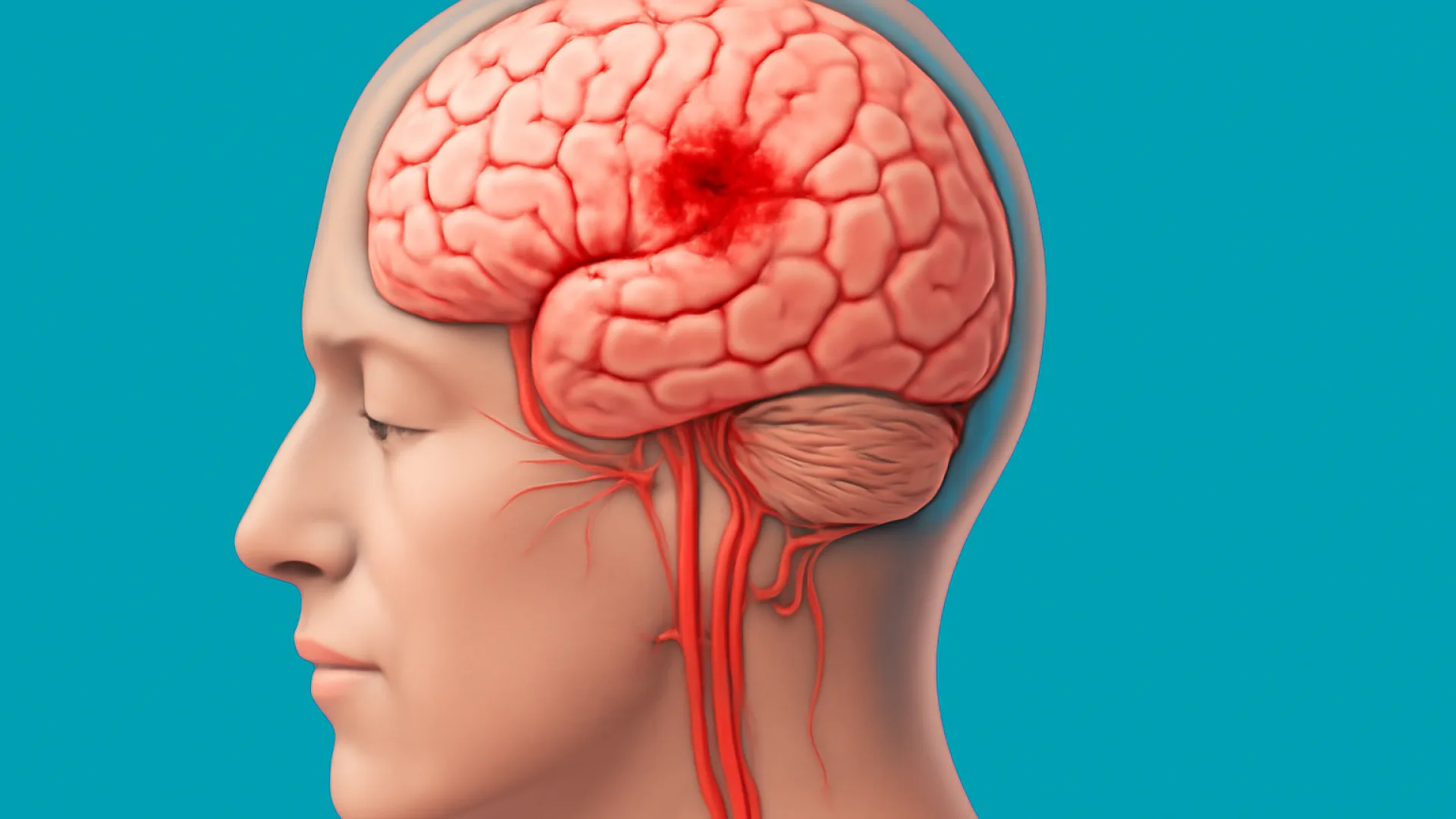 SAH (Subarachnoid Hemorrhage)