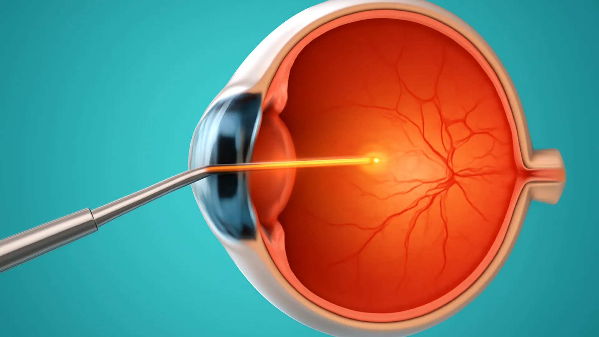 Tabel: Ablasio Retina