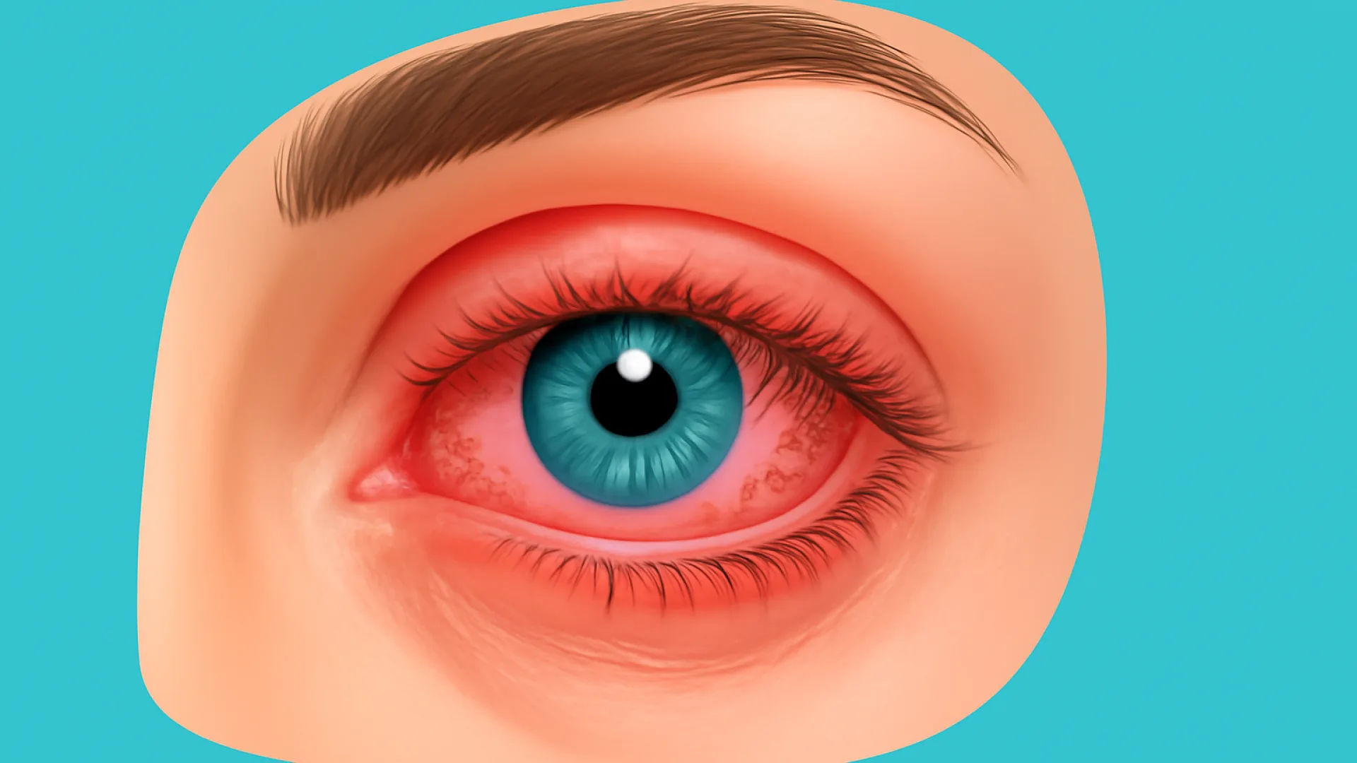 Konjungtivitis Vernal