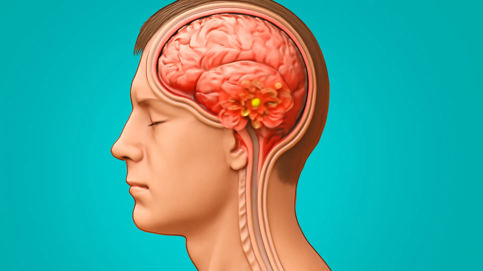 Meningitis Bakterial