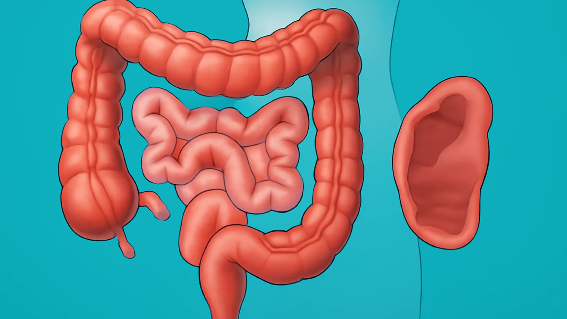 Ileus Obstruktif vs Paralitik