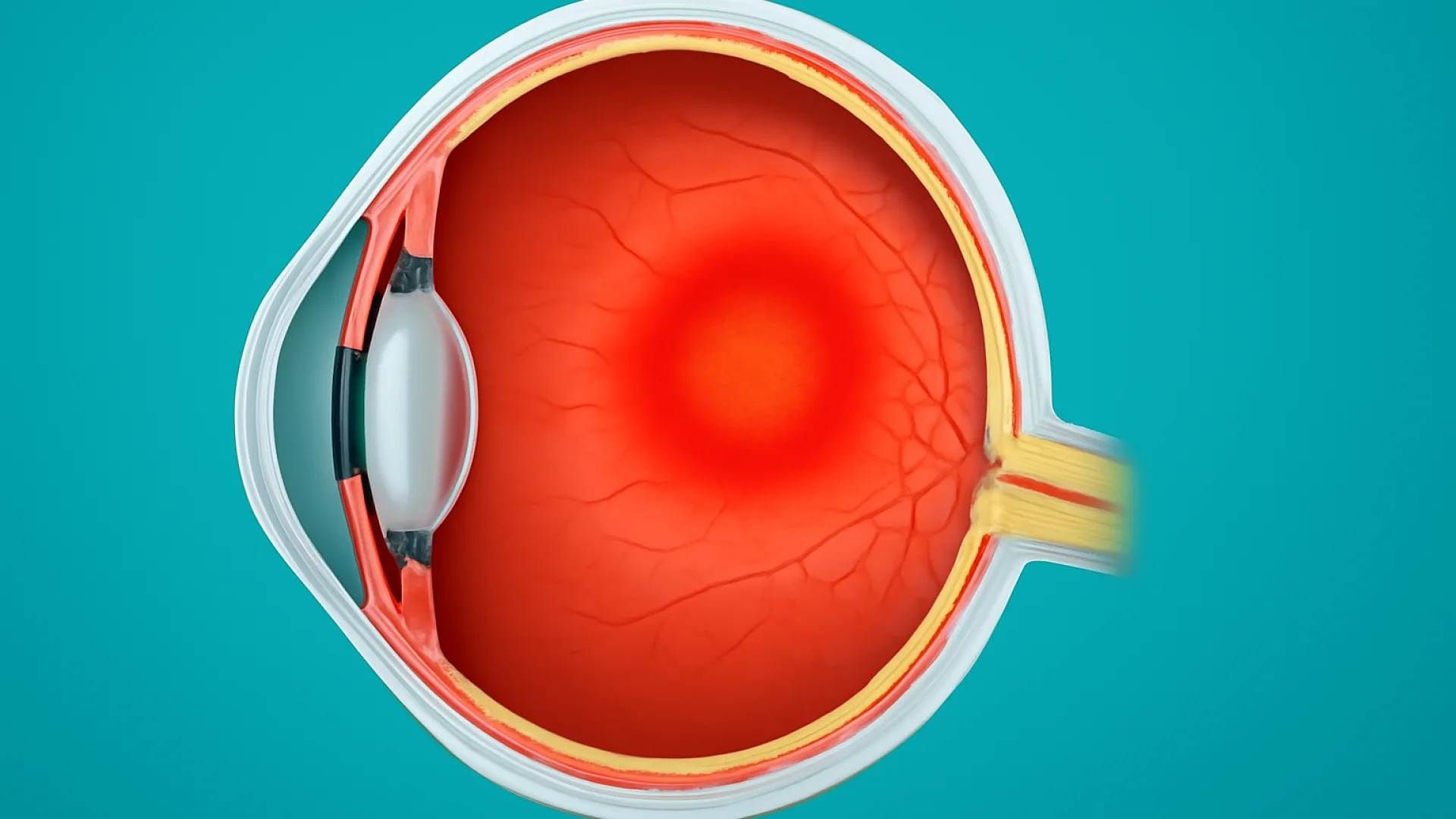 Uveitis Posterior / Panuveitis