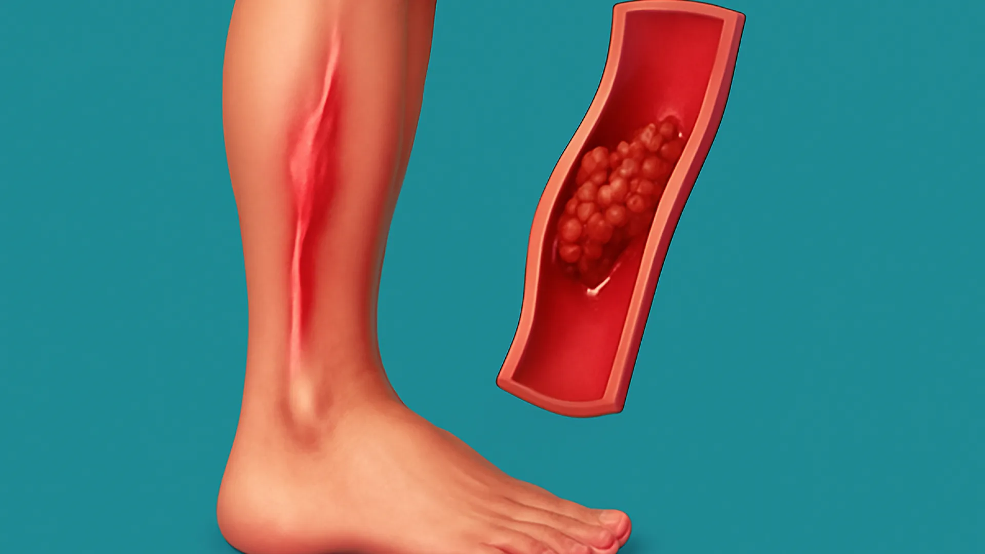DVT / Tromboflebitis Superfisial