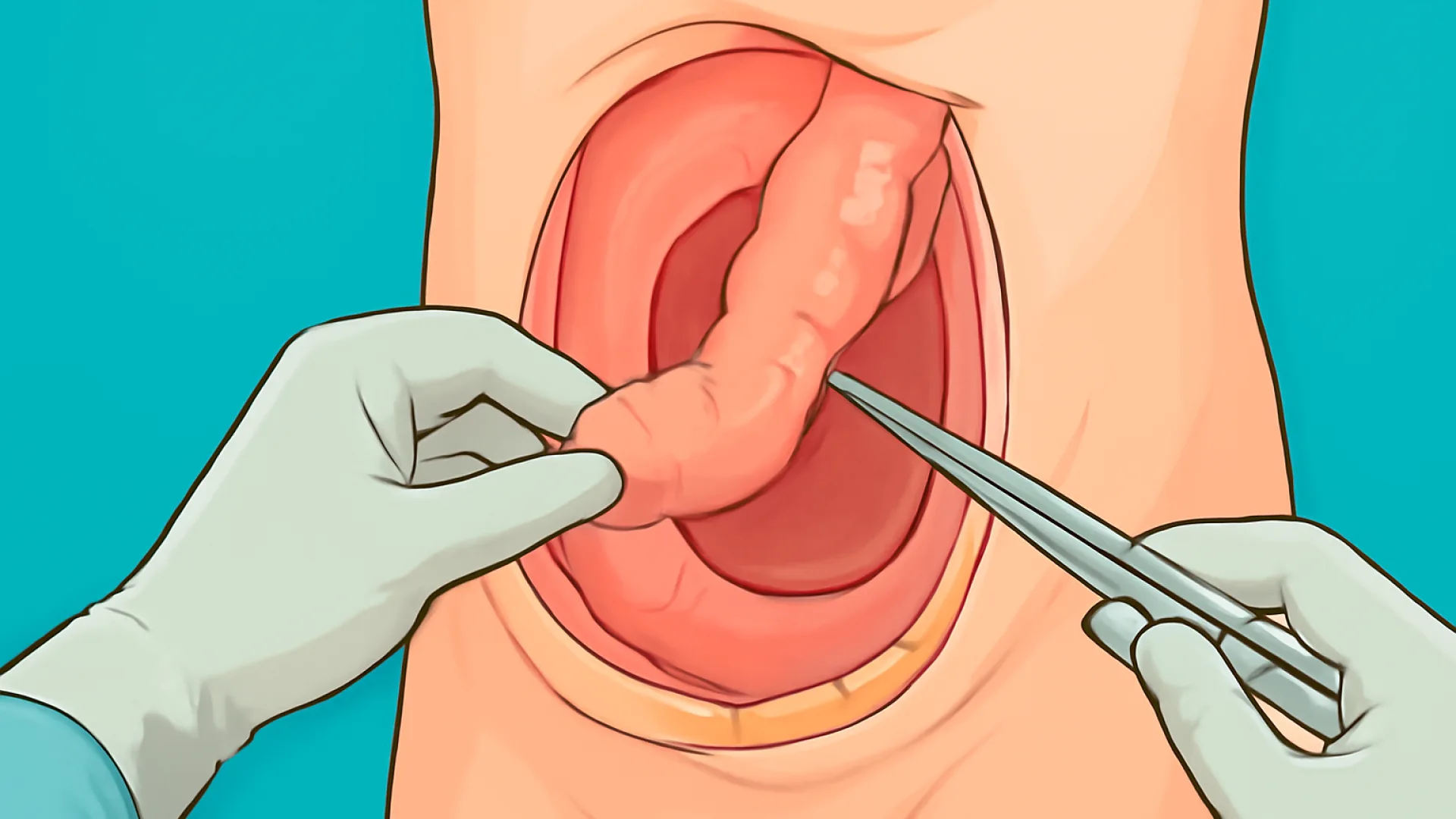 Tabel Hernia