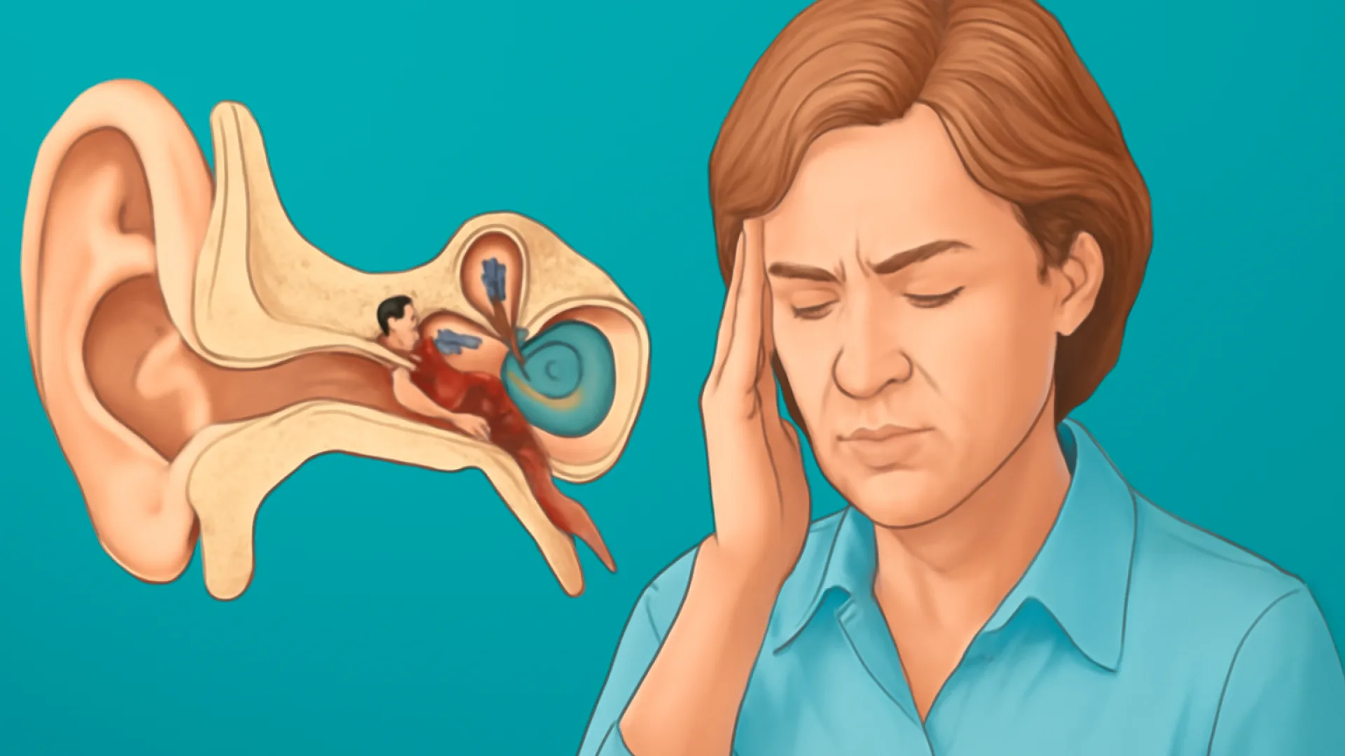 Vestibular Neuritis / Meniere
