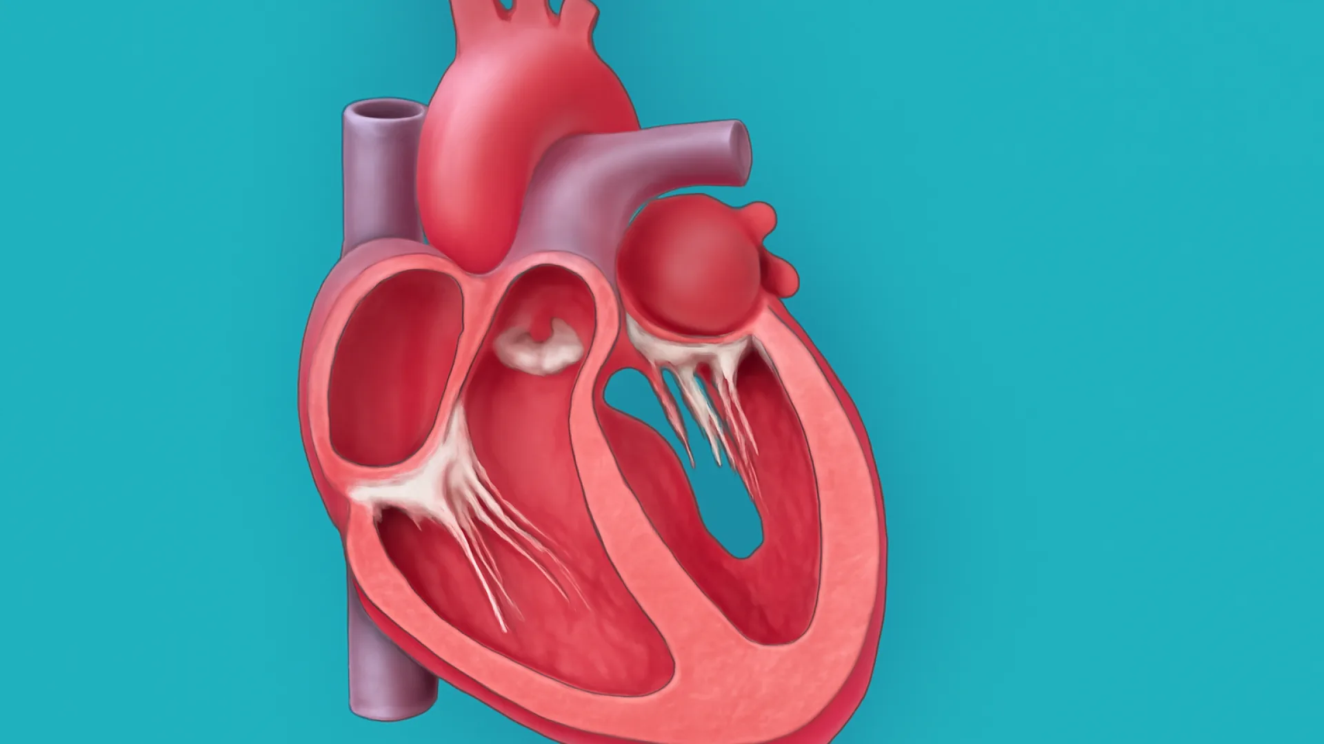 Regurgitasi Trikuspid / Pulmonal